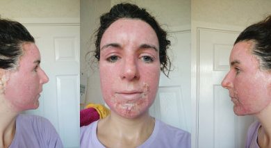 Photo of The Five Most Brutal Laser Treatment Risks