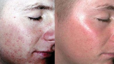 Photo of Laser Treatment Treatment – Appointment Frequency