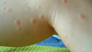 Photo of Bear In Mind: Bleach – A Toxic Chigger Treatment