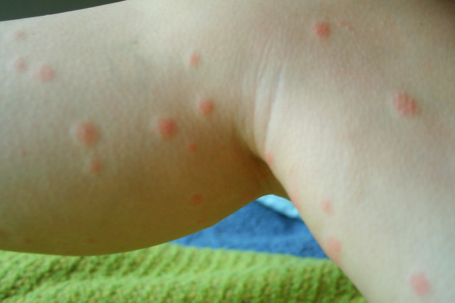 Bear In Mind: Bleach – A Toxic Chigger Treatment