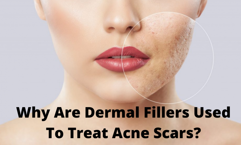 dermal fillers in Canberra