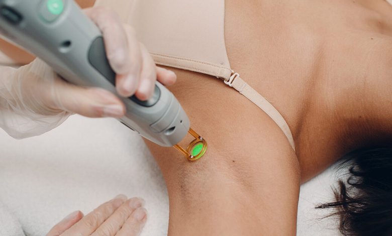 Laser Hair Removal