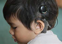 Cochlear Implant