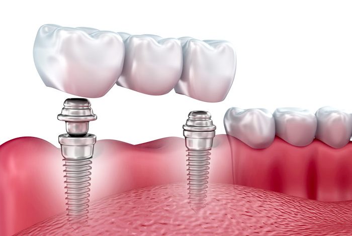implant retained dentures