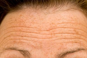 Face Taping Wrinkles